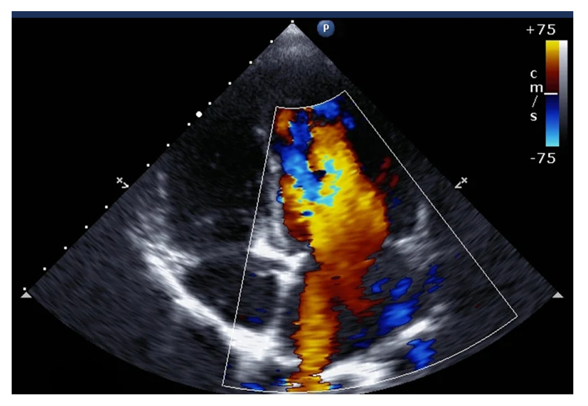 Echocardiogram